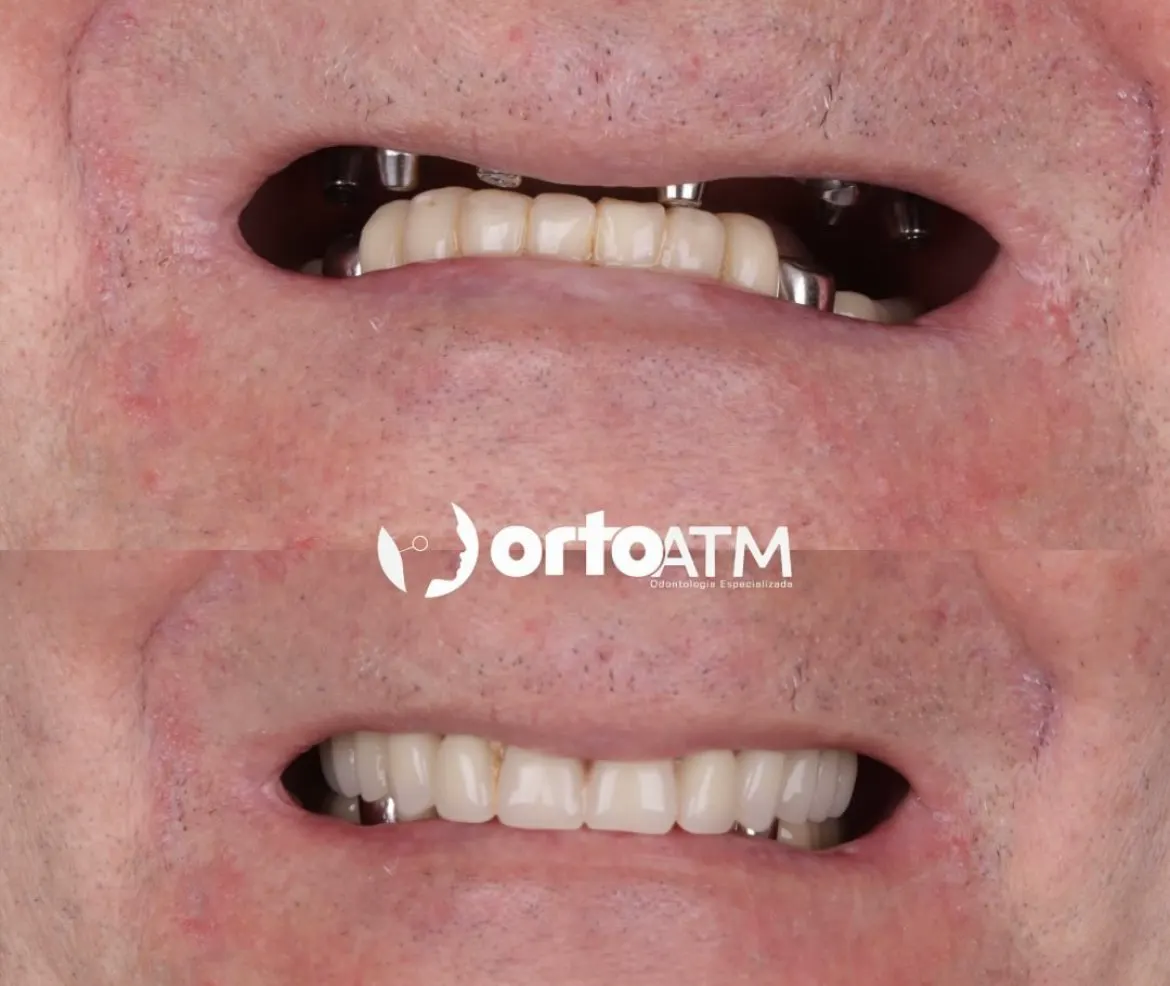 Antes e depois de prótese protocolo — caso 1