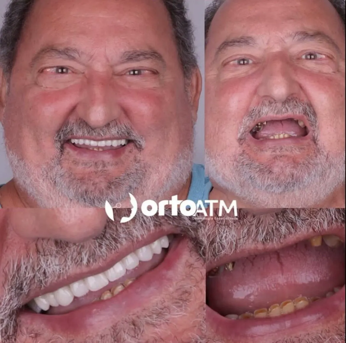 Antes e depois de paciente que trocou a dentadura por prótese protocolo na OrtoATM